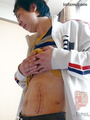 失去左肾的胡杰。(朝格图/图) 失去左肾的胡杰。(朝格图/图)