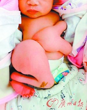 4手4脚的男婴。(图片来源广东台)