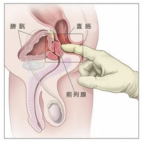 前列腺癌