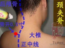 颈椎病的艾灸疗法